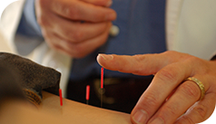 Acupuncture